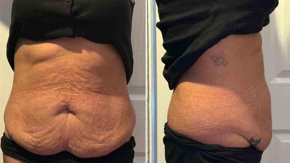 Lost the Weight but Not the Loose Skin? What You Should Know 1 Is It Definitely Loose Skin Rushden?